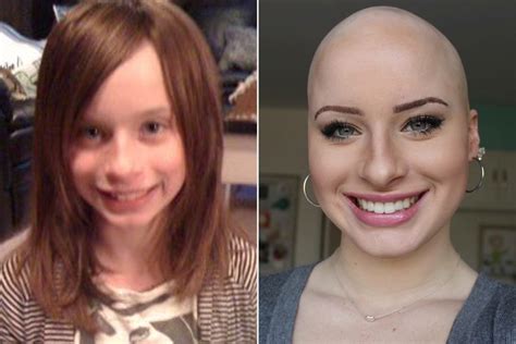 bald chloe|Chloe Bean .